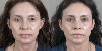 Face Lift Patient 24