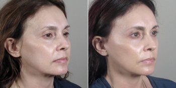 Face Lift Patient 24