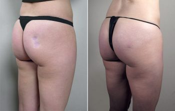 Body Filler Patient 4 – Fat Injection