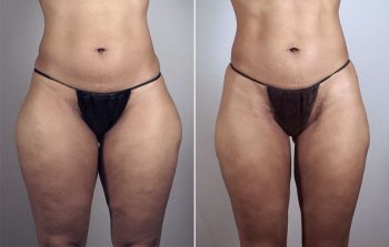 Liposuction Patient 40
