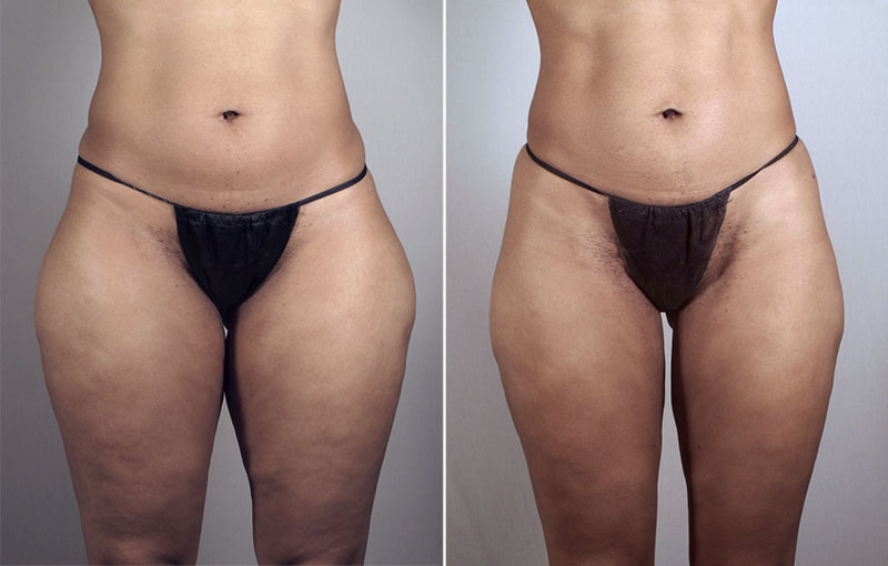 Liposuction Patient 40