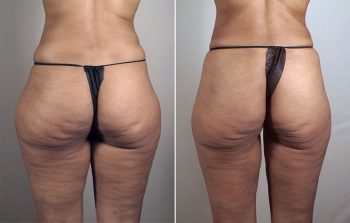 Liposuction Patient 40