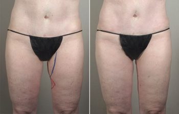 Body Filler Patient 1 – Fat Injection