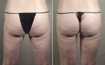 Body Filler Patient 1 – Fat Injection