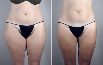 Brazilian Butt Lift Patient 1