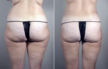 Brazilian Butt Lift Patient 1