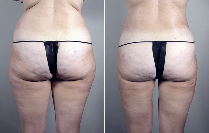 Brazilian Butt Lift Patient 1