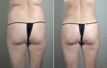 Liposuction Patient 42