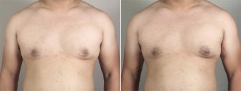 Male Inverted Nipple Correction Patient 1
