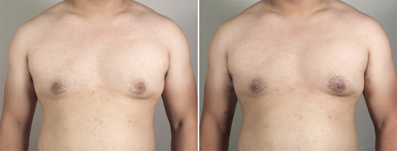 male-gynecomastia-4a Breast Reduction for Men New Jersey Photo