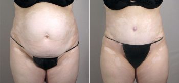 Mommy Makeover Patient 25