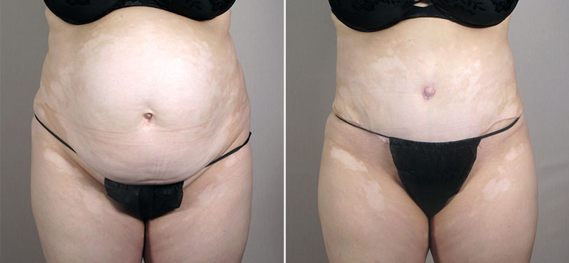 Mommy Makeover Patient 25