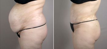 Mommy Makeover Patient 25