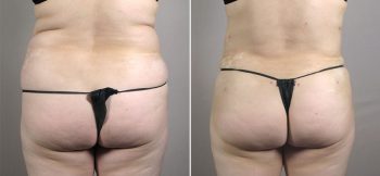 Mommy Makeover Patient 25