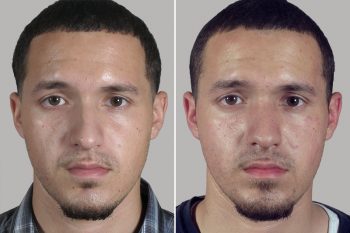 Male Rhinoplasty Patient 15