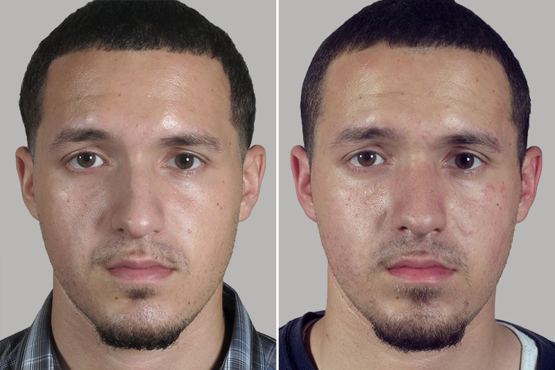 Male Rhinoplasty Patient 15