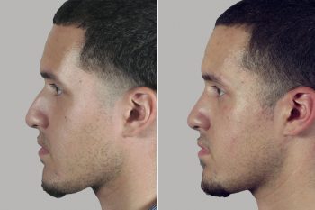 Male Rhinoplasty Patient 15