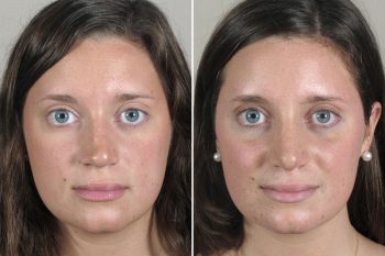 Rhinoplasty Patient 35