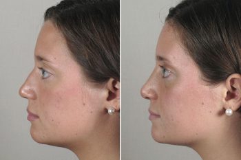 Rhinoplasty Patient 35