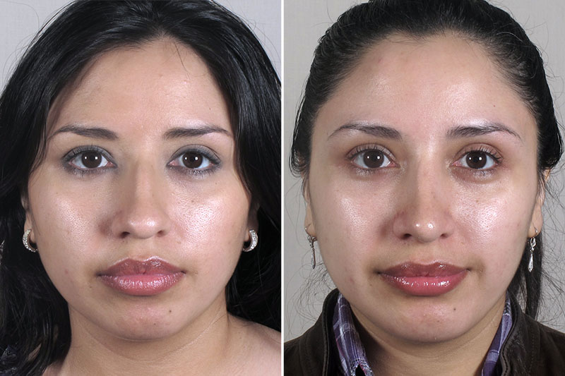 Rhinoplasty & Chin Implant Patient 36