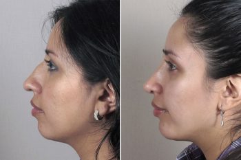 Rhinoplasty & Chin Implant Patient 36
