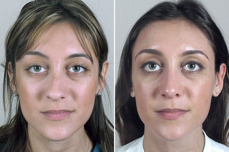 Rhinoplasty Patient 37