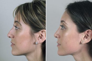 Rhinoplasty Patient 37