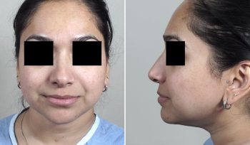 Rhinoplasty Patient 38