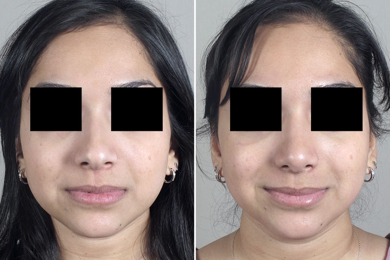 Rhinoplasty Patient 38