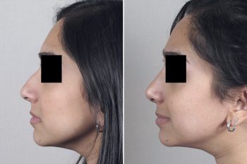 Rhinoplasty Patient 38