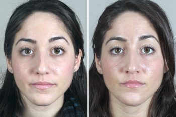 Rhinoplasty Patient 39