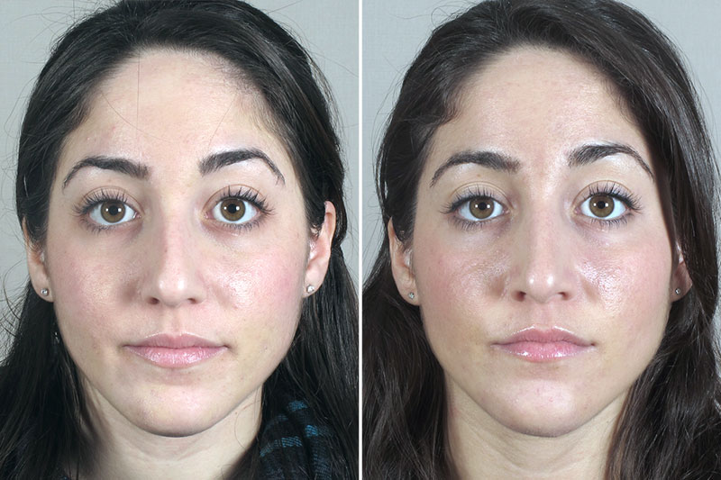 Rhinoplasty Patient 39