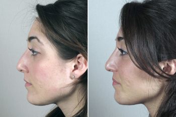 Rhinoplasty Patient 39