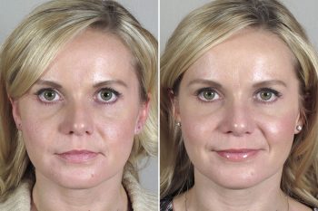 Rhinoplasty Patient 40