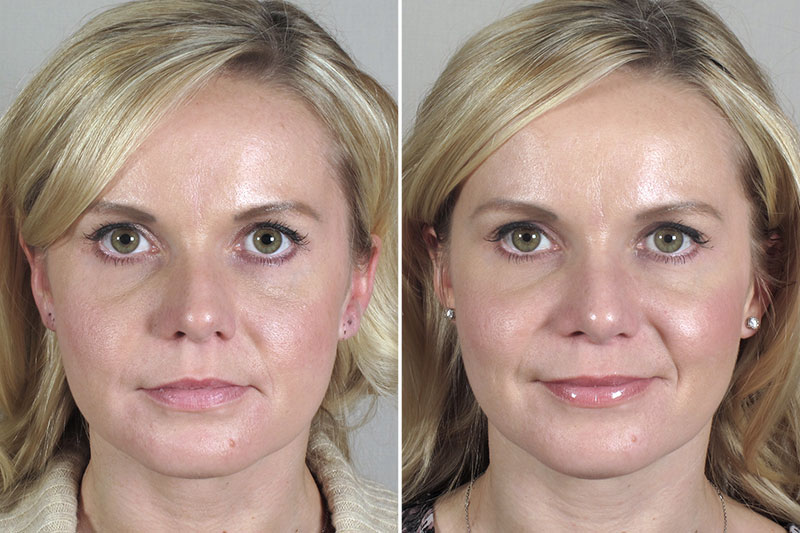 Rhinoplasty Patient 40