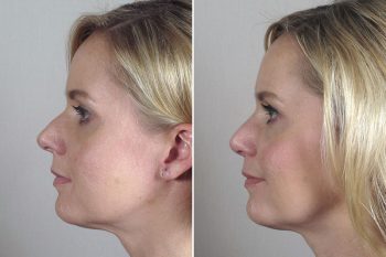 Rhinoplasty Patient 40