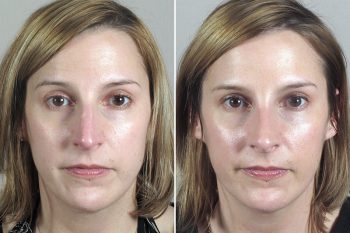 Rhinoplasty Patient 41