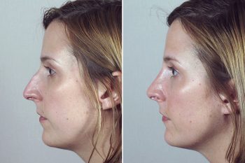 Rhinoplasty Patient 41