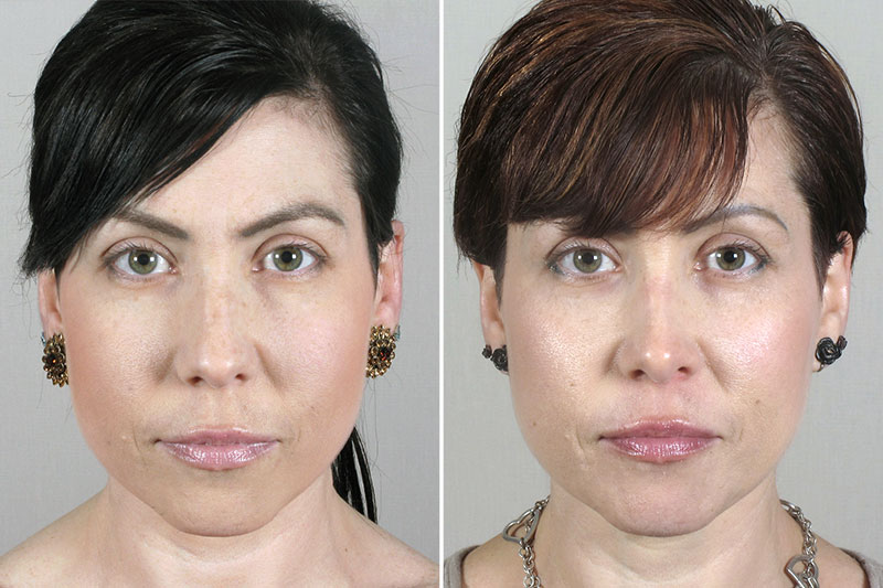 Rhinoplasty Patient 42
