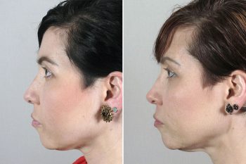 Rhinoplasty Patient 42