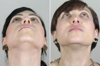 Rhinoplasty Patient 42