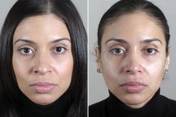 Rhinoplasty Patient 43