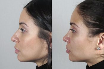 Rhinoplasty Patient 43