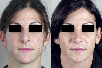 Rhinoplasty Patient 44