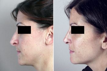 Rhinoplasty Patient 44