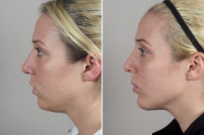 New Jersey Chin Implant with Neck Contouring