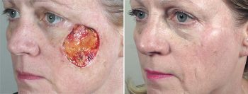 Skin Cancer Treatment Patient 39
