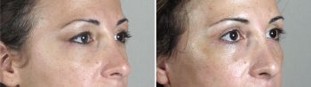 Face Lift Patient 23