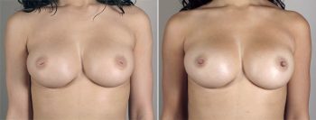 Inverted Nipple Correction Patient 11