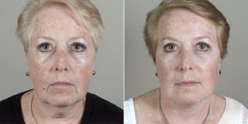 Face Lift Patient 25